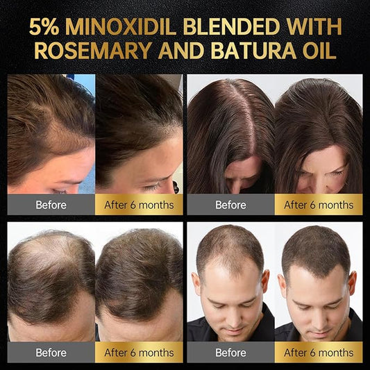 Minoxidil for Men & Women, With Biotin, Batana Oil, Rosemary Essential Oil, Effective Hair Loss Solution,